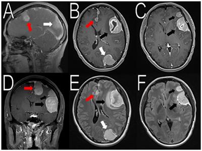 Somatic SMARCB1 Mutation in Sporadic Multiple Meningiomas: Case Report